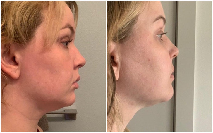 “Finally seeing a difference in my chin after lipo, 9.5-week post-op.”