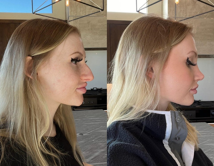 “Rhinoplasty before/after — 10 weeks post-op update”