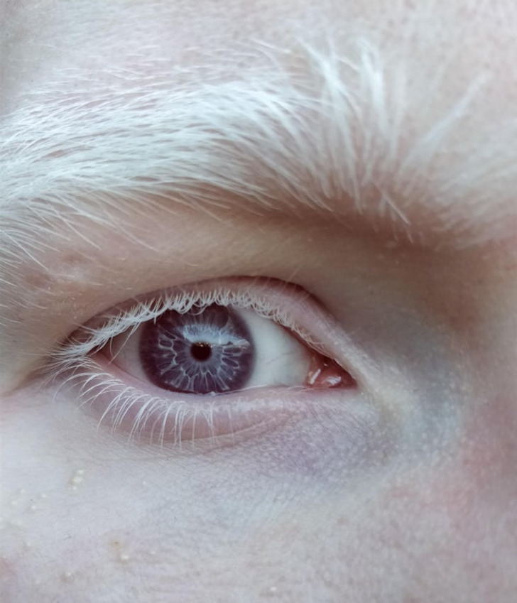 rare human features - albino purple eyes