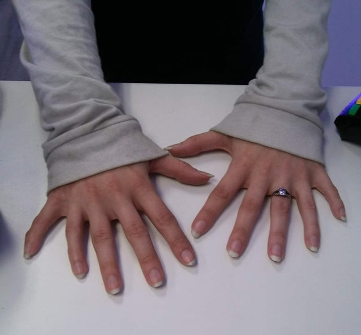 rare human features - woman with 12 fingers