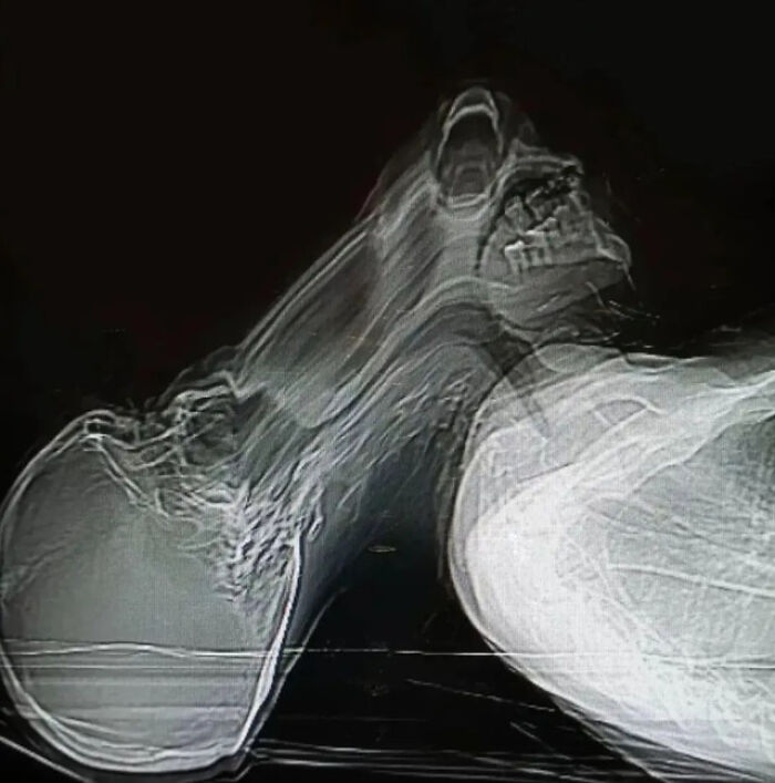 terrifying photos - A Patient With Claustrophobia Panicking During A Ct Scan