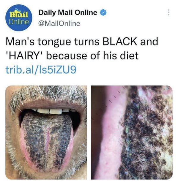 people who shared too much - black hairy tongue - mail Daily Mail Online Online Man's tongue turns Black and 'Hairy' because of his diet trib.al1s5iZUS