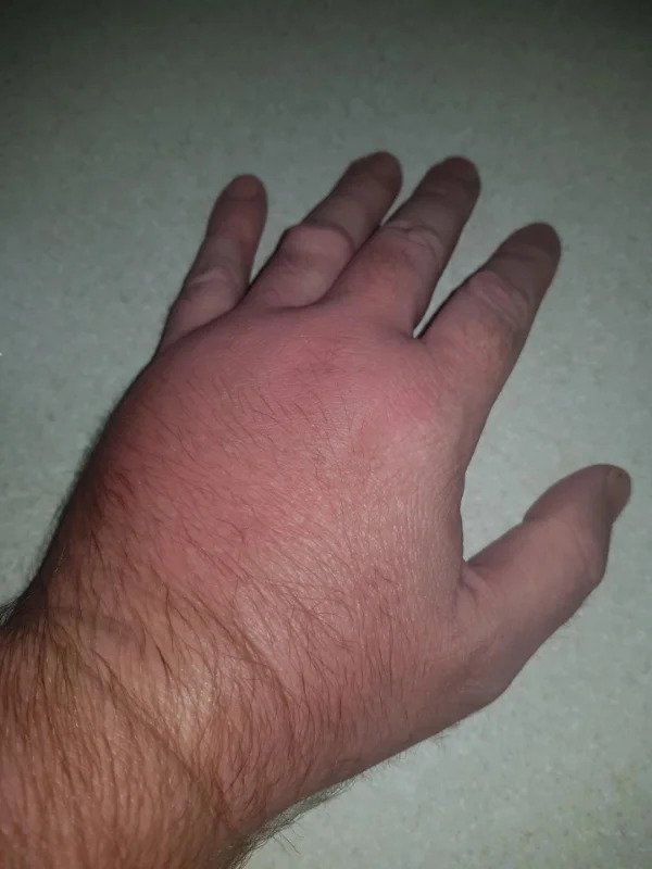 “Moved to Australia and was warned about the snakes and spiders. I give you a single ant bite.”