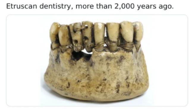 WTF History - ancient egyptian dentistry - Etruscan dentistry, more than 2,000 years ago.