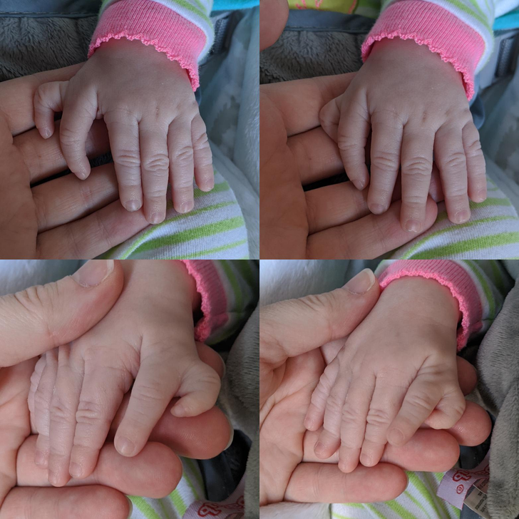 “My youngest daughter was born this February with an extra finger on each hand.”