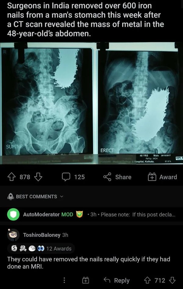 savage comments - let me guess florida meme - Surgeons in India removed over 600 iron nails from a man's stomach this week after a Ct scan revealed the mass of metal in the 48yearold's abdomen. R. Supine Erect 48 Yrs Male 20162017 Rolby Mch Hospital, Kolk