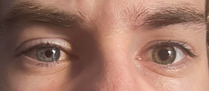 “I have complete heterochromia AND physiologic anisocoria (different sized pupils).”
