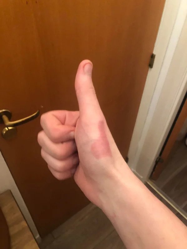 “Thumbs up burn on a up thumb.”