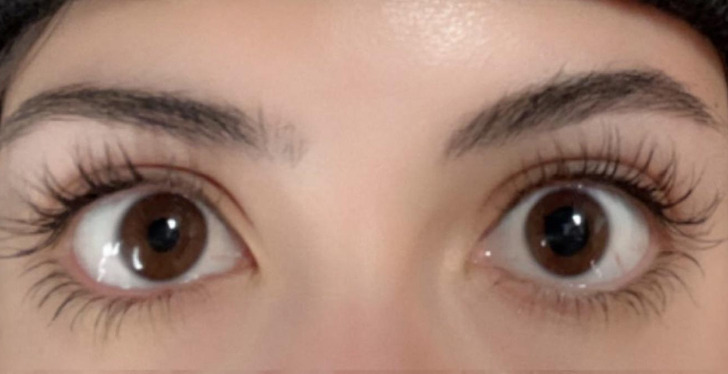 “My pupils were different sizes for a few hours after the eye doc dilated them and had to rescan my left optic nerve.”