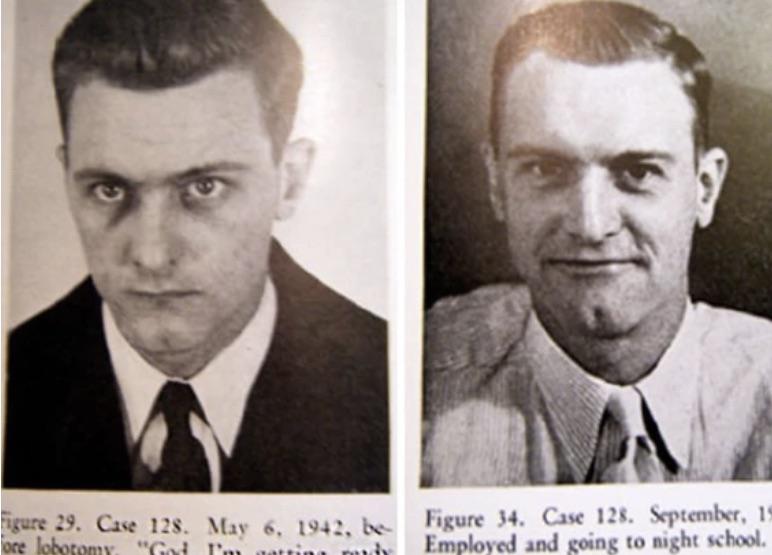 Picture of a man with Schizophrenia before and after his Lobotomy