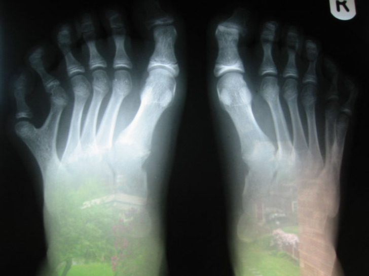 “My brother was born with 12 toes. Here’s the X-ray.”