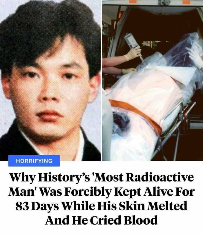 weird and wtf facts - hisashi ouchi - Horrifying Why History's 'Most Radioactive Man' Was Forcibly Kept Alive For 83 Days While His Skin Melted And He Cried Blood