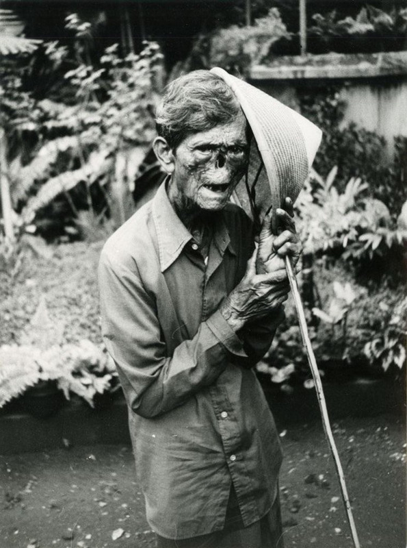 An Indonesian man suffering from leprosy. 1984.