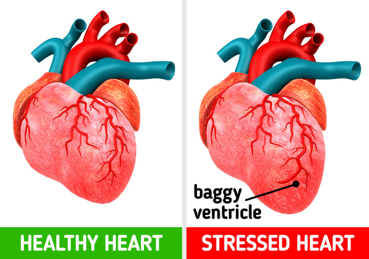 This might sound like a cliché, but stress can literally change the shape of your heart. Takotsubo syndrome is a condition that causes the left ventricle to change shape and fail to pump blood properly. During short-term stress, 2 molecules known to be released during stress and depression can affect the activity of heart muscle cells, leading to a temporary failure. Luckily, managing stress and practicing breathing and meditation techniques cure this condition without the need for medication.