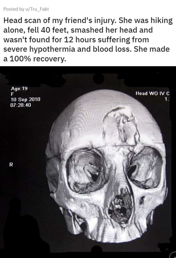 creepy pics - head - Posted by uTru_Fakt Head scan of my friend's injury. She was hiking alone, fell 40 feet, smashed her head and wasn't found for 12 hours suffering from severe hypothermia and blood loss. She made a 100% recovery. Age 19 F 40 R Head Wo 