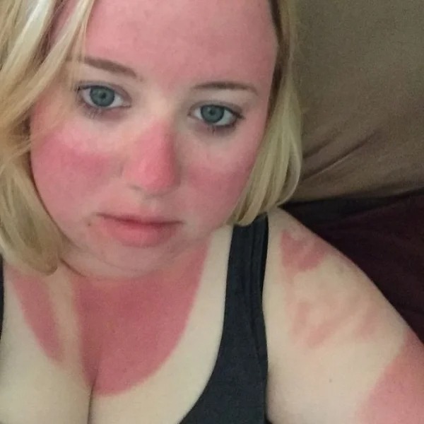 28 Sunburns That Are Really Painful.