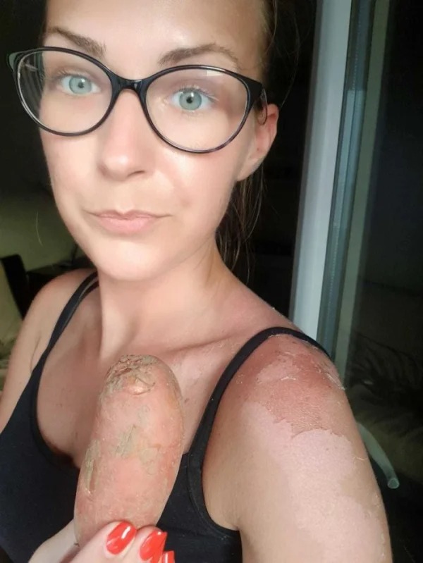 28 Sunburns That Are Really Painful.