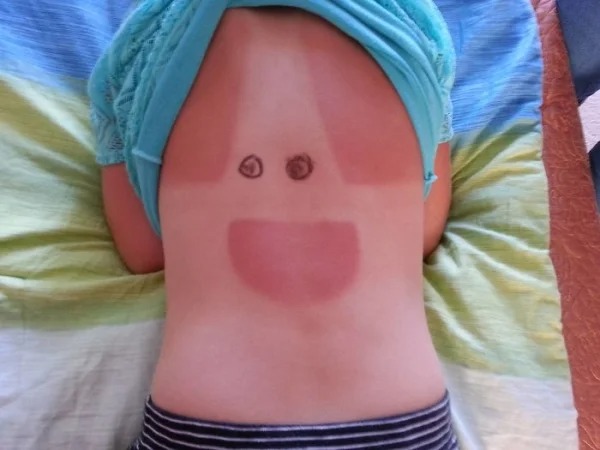 28 Sunburns That Are Really Painful.