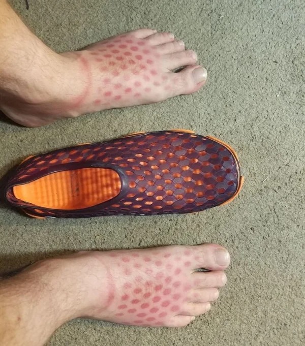 28 Sunburns That Are Really Painful.