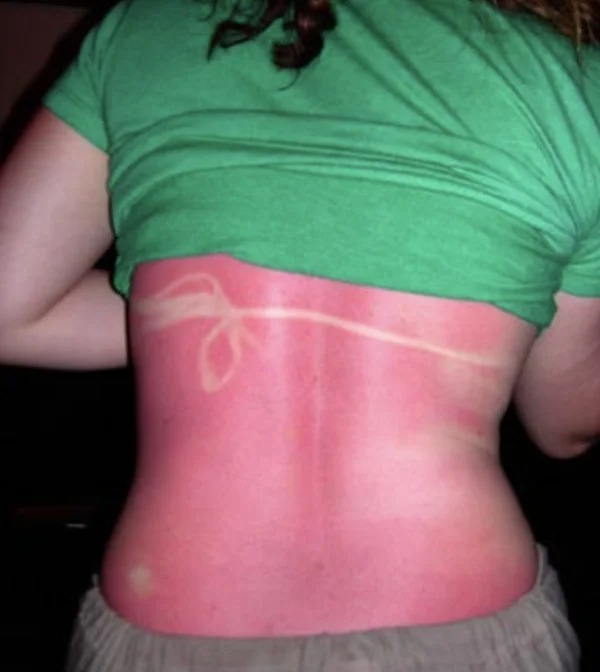 28 Sunburns That Are Really Painful.