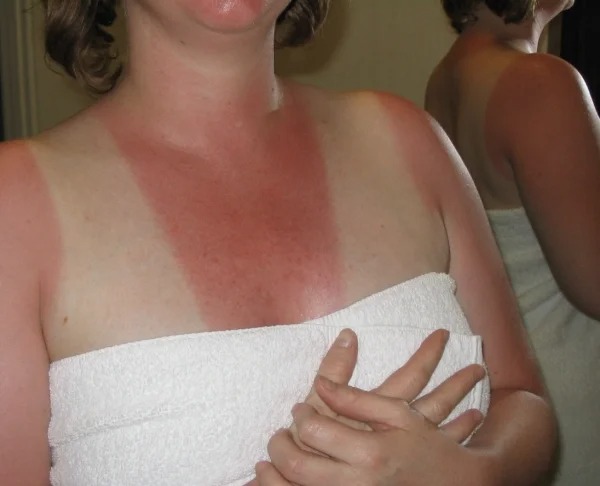 28 Sunburns That Are Really Painful.