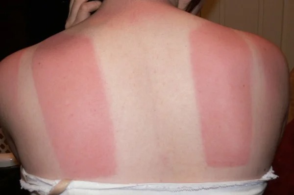 28 Sunburns That Are Really Painful.