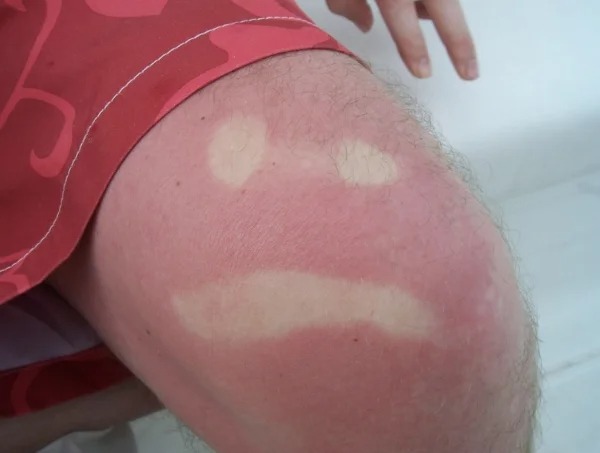 28 Sunburns That Are Really Painful.