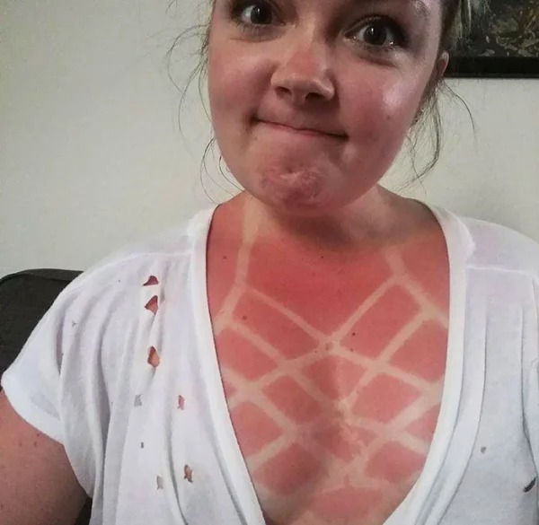 28 Sunburns That Are Really Painful.