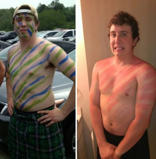 28 Sunburns That Are Really Painful.