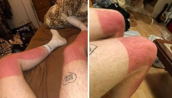 28 Sunburns That Are Really Painful.