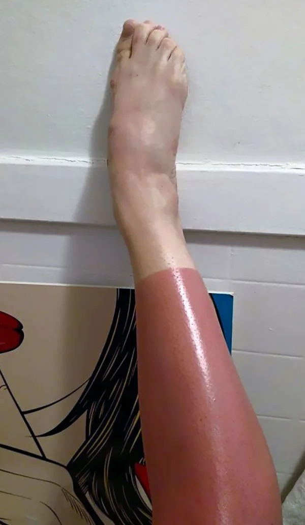 28 Sunburns That Are Really Painful.