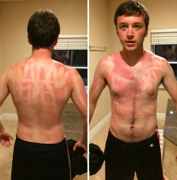 28 Sunburns That Are Really Painful Facepalm Gallery Ebaums World