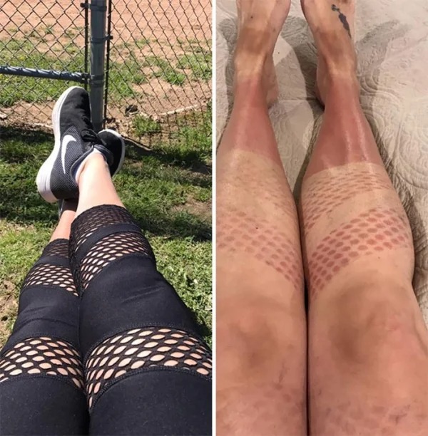 28 Sunburns That Are Really Painful.