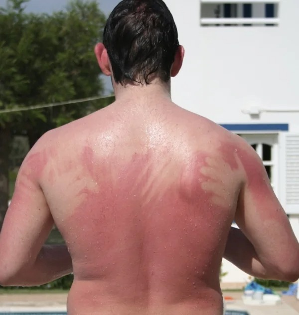 28 Sunburns That Are Really Painful.