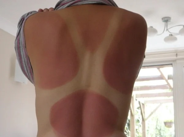 28 Sunburns That Are Really Painful.