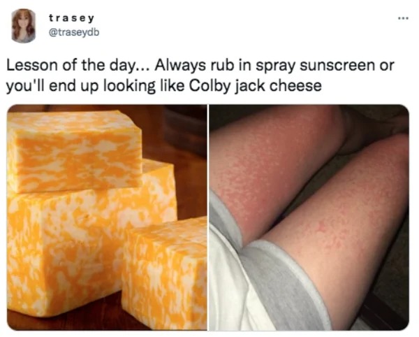 28 Sunburns That Are Really Painful.