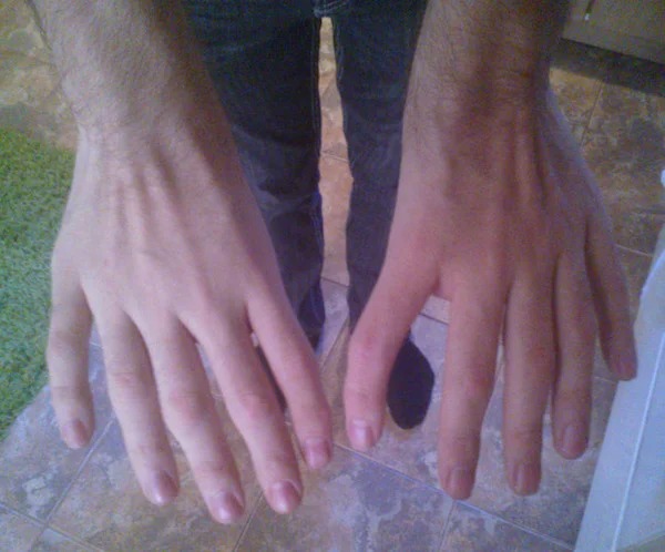 genetic anomalies - cool mutations - person with 10 fingers