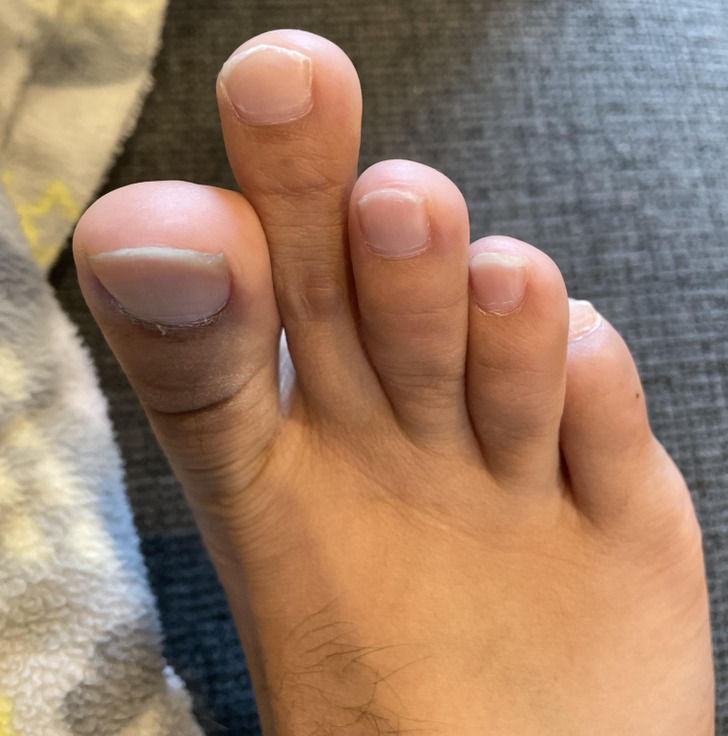 “My second toe is a lot longer than the rest of my foot.”