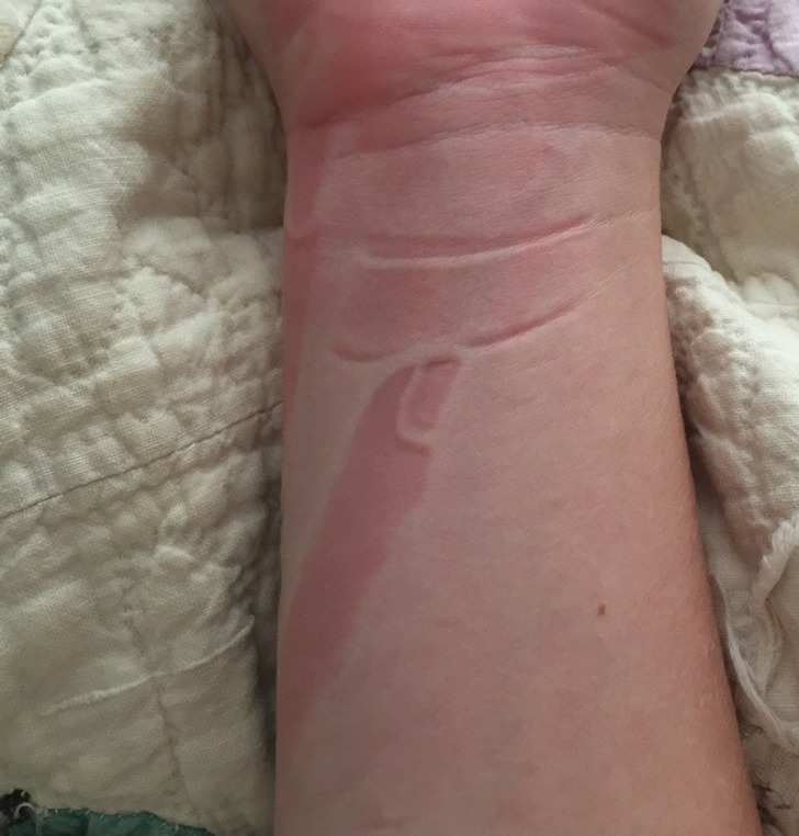 “I slept on my finger and it left a perfect imprint on my arm.”