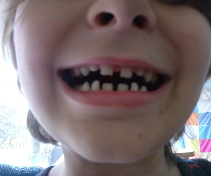 “My nephew has the Batman symbol in the gaps of his teeth.”