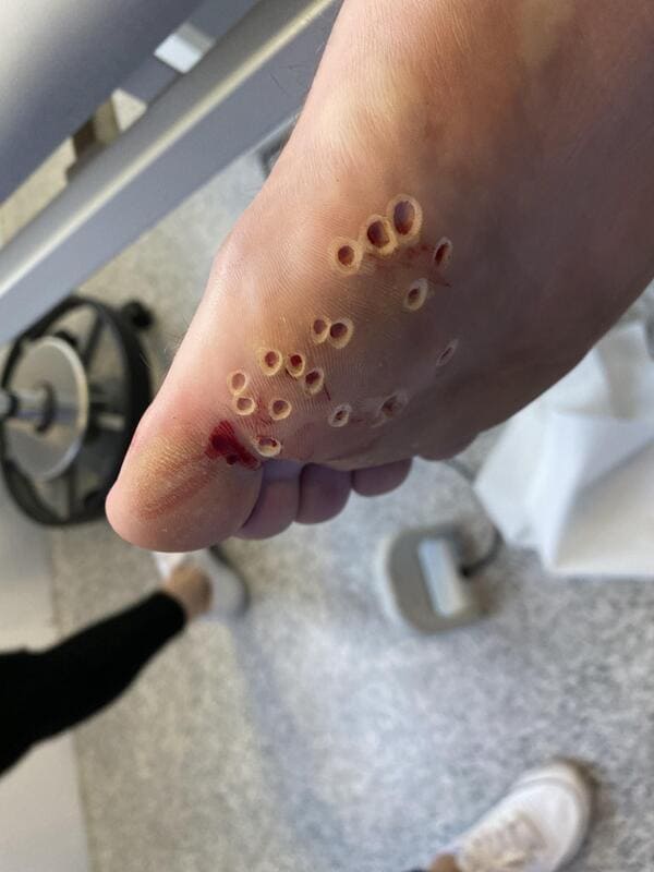 Gross but satisfying photos - wart removed - C
