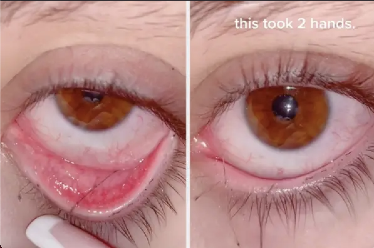 Gross but satisfying photos - eye - this took 2 hands.