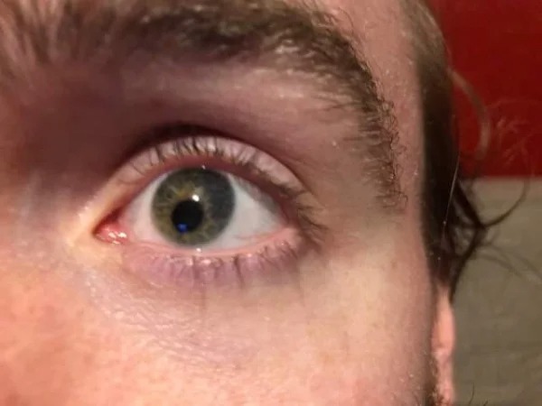 “Off centered pupil I’ve had since birth.”