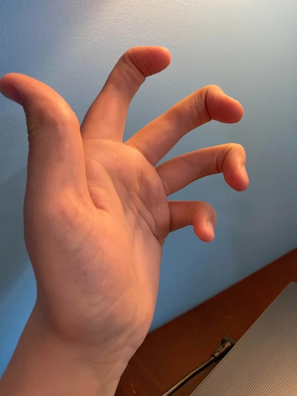 This person has no middle joints in any of their fingers!