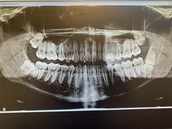 5 wisdom teeth oh boy.