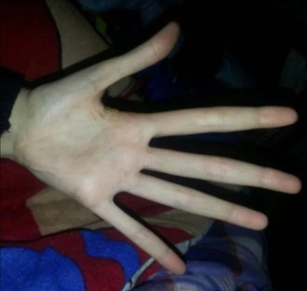 This is the hand of someone with Marfan’s syndrome.