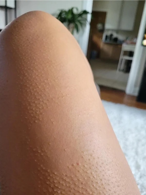 This person has a patch of skin that doesn’t get goosebumps.