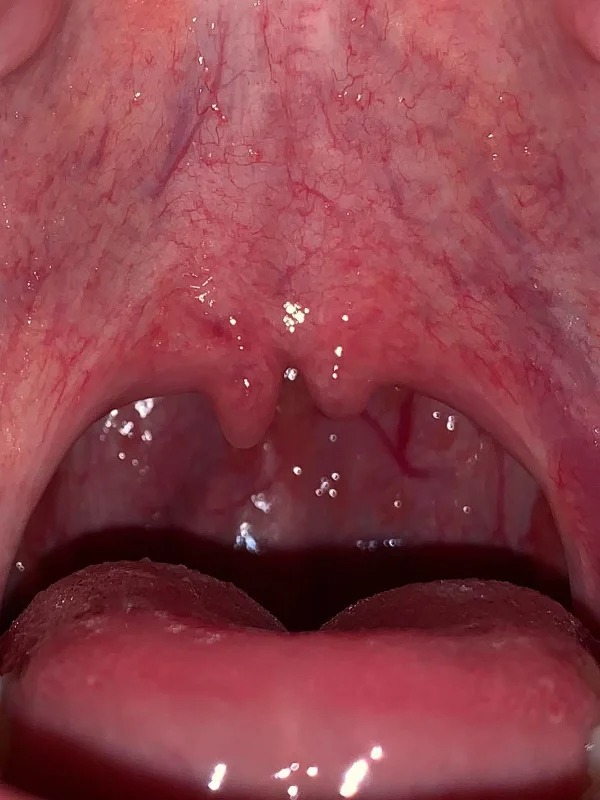 This is known as a bifid uvula.