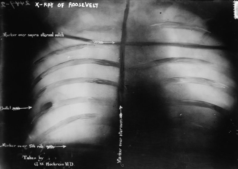 Chest x-ray of Theodore Roosevelt taken on 14 October 1912 after he was shot during an assassination attempt. Doctors deemed the bullet too dangerous to remove and Roosevelt carried it for the rest of his life