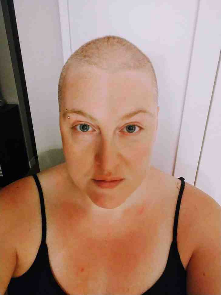 “I was losing my hair due to anxiety. Here’s my first hairless picture, I’m still worthy of happiness.”